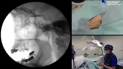 Dr Agnes Stogicza - Radiofrequency E-Learning Seminar 3 Session 2: Sphenopalatine ganglion RFA