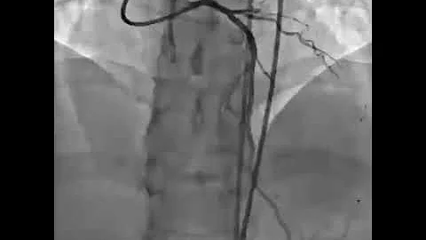 Reverse CART. CTO RCA.