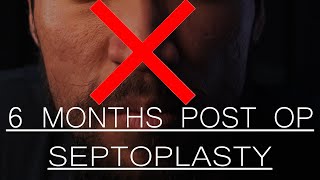 SEPTOPLASTY 6 MONTHS POST OP | double turbinate reduction | ENS???