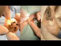 15 minutes cyst removal compilation  cyst and blackhead poppings  pimple popping 8