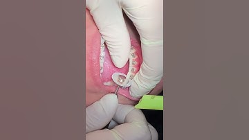 Interproximal Reduction (IPR) Orthodontics