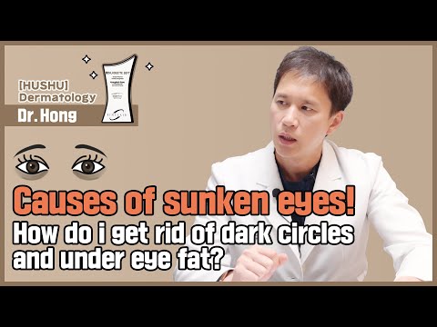 [HUSHU] Causes of sunken eyes - How do I get rid of dark circles and under eye fat ?