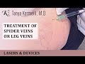 Treatment of spider veins or leg veins