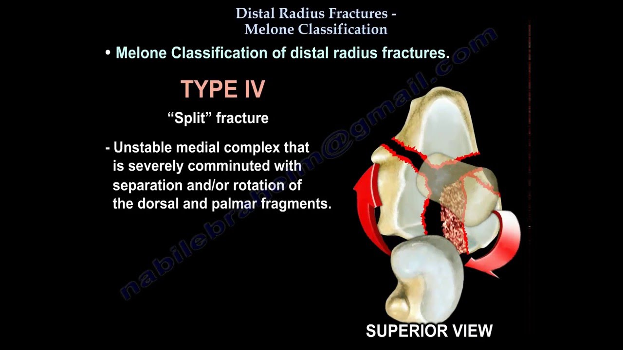 Distal Radius Fracture Melone Classification - Everything You Need To Know - Dr. Nabil Ebraheim