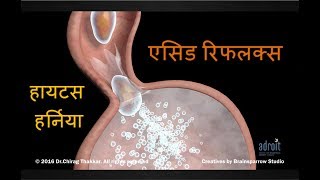 एसिड रिफ्लक्स, एसिडिटी, Hiatus Hernia और GERD  की संपूर्ण जानकारी  Acid Reflux (Acidity, heartburn)