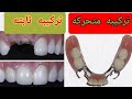 الفرق بين التركيبات المتحركه للاسنان و التركيبات الثابته للاسنان 