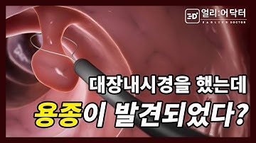 대장내시경 중 대장용종이 발견되었다! 나는 암일까?