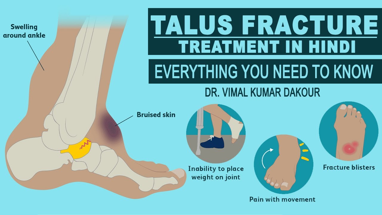 Talus Fracture - Everything You Need To Know - Dr. Vimal Kumar Dakour |  Treatment in Hindi