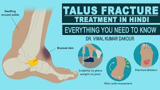 Talus Fracture - Everything You Need To Know - Dr. Vimal Kumar Dakour | Treatment in Hindi