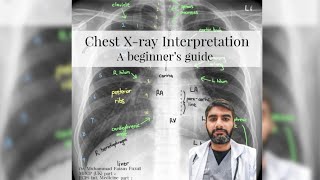 Chest Xray Interpretation: Learn Chest Xray in only 10 minutes