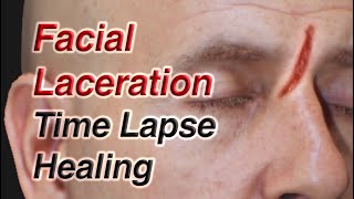 Facial Laceration Time Lapse Healing via Secondary Intention