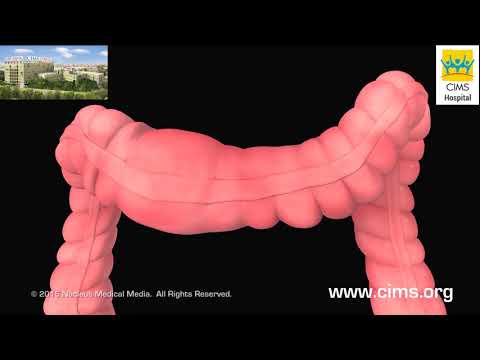 Irritable Bowel Syndrome (Gujarati) - CIMS Hospital