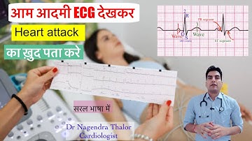 Check heart attack ECG by yourself l ईसीजी देखकर ख़ुद पता करे हार्ट अटैक I #drnagendrathalor