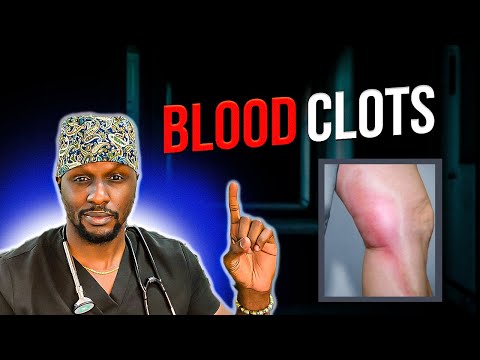 Blood Clot Dangers: Learn the Warning Signs