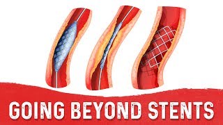 Stents May be the Patch, But Whats the Fix – Dr.Berg
