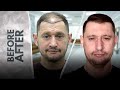 5300 Grafts Hair Transplant Result in One Session – Mature Hairline &amp; Clean Donor Area