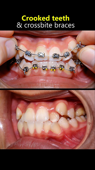 Braces transformation. From crooked smile to perfect smile #braces #orthodontist #dentist #teeth