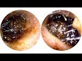 Mountains of Ear Wax Removed from Both Ears - #400