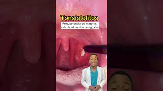 Tonsilolito 