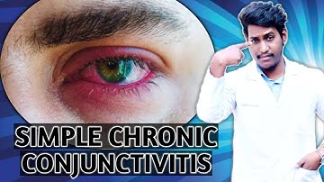 chronic conjunctivitis || simple chronic conjunctivitis || chronic bacterial conjunctivitis ~2021
