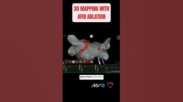 Watch the full video of Dr. Gallinghouse’s insightful talk: “AFib Ablation: What You Need to Know!