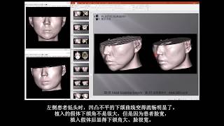 [H整形医院] 下颌角修复手术 (사각턱 재건수술 후기)