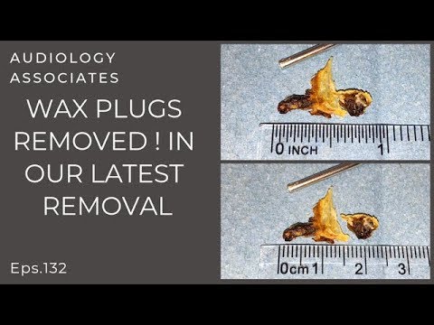 EAR WAX PLUGS REMOVED - EP 132