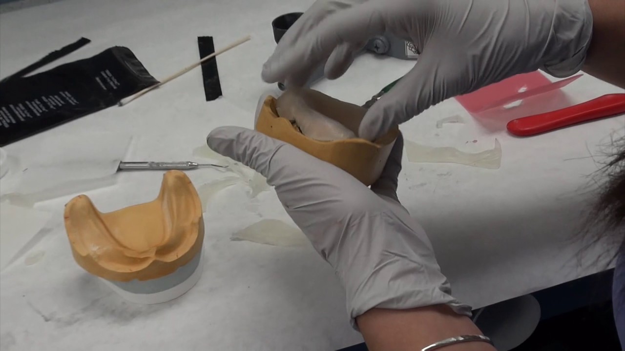 Custom Impression Trays Part 2 of 3 Placing the triad with handle