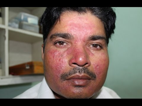 Acne Roacea of  years cured by Homeopathy  Dr Ravi Singh