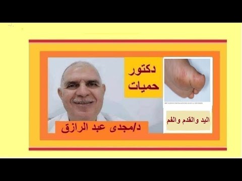 مرض اليد والقدم والفم ومسبباته