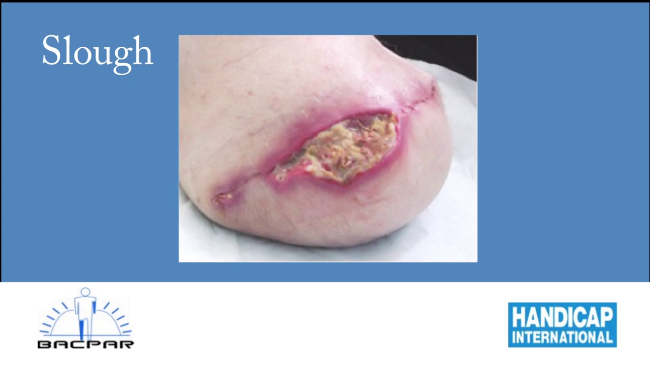 Amputation in conflict and disaster: wounds