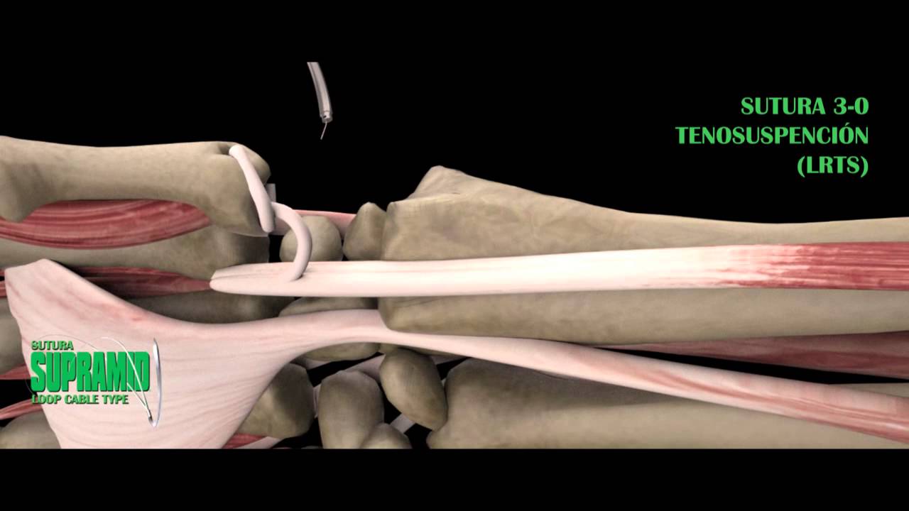 Pulgar Trapecio Tenosuspensión (LRTS) YouTube