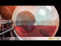 Augen OP Das Passiert Bei Der Vitrektomie Glaskörperabsaugung
