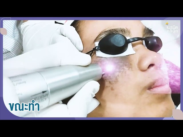 รักษาปาน EP.2/ปานที่โหนกแก้ม ตั้งแต่กำเนิดรักษายังไง #หมอปุ๊เนรมิตคลินิก  @NERAMIT TV 