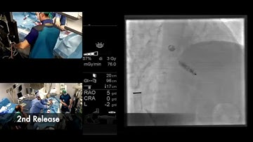 Micra Leadness Pacemaker Implant & AV Node Ablation