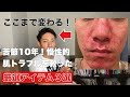 【ニキビ撲滅】10年以上慢性化したニキビを治すアイテム３選