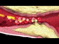 Heart attack myocardial infarction thrombosis 3d medical animation company studio 3d visualization h