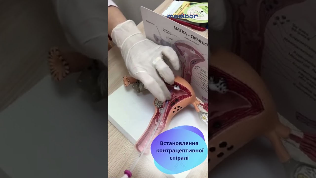 Встановлення контрацептивної спіралі: надійний захист протягом тривалого часу