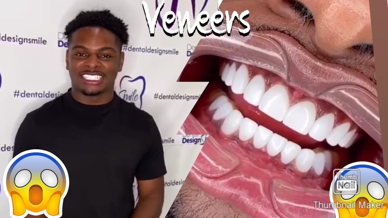 I FLEW TO MIAMI TO BUY VENEERS!!!! YouTube