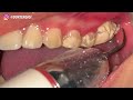 SCALING | TARTAR | CALCULUS | Dentist | Dokter Gigi Tri Putra