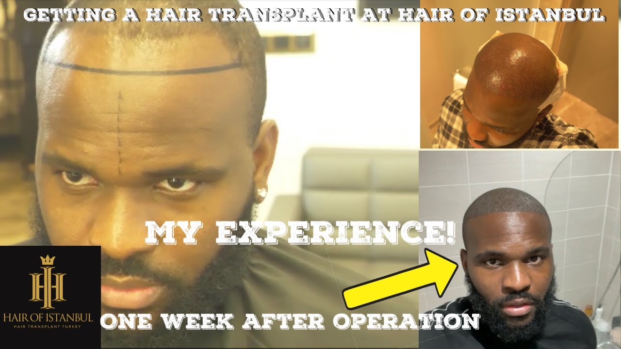 GETTING A HAIR TRANSPLANT AT THE HAIR OF ISTANBUL TURKEY | MY EXPERIENCE + ONE WEEK HAIR UPDATE!