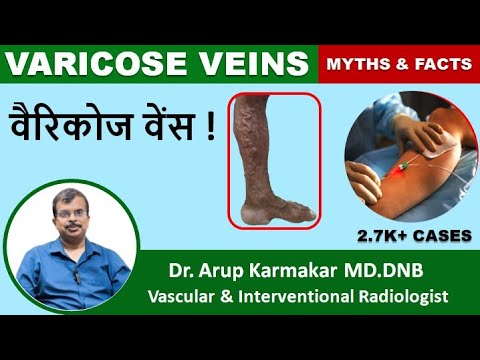 Varicose Veins वैरिकोज वेंस | MYTHS & FACTS | Know From Experts | Dr ...