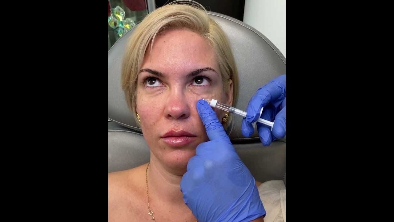 Under Eye Filler