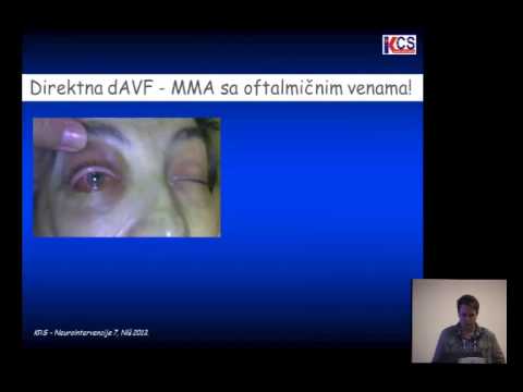 Video: Vrste Afazije: Definicije, Grafikon, Suočavanje I Tretmani