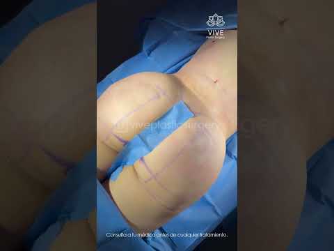 Refine your shape💖Lipo BBL at Vive Plastic Surgery #tijuana 🤩