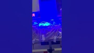 Baby ko hua jaundice treatment by phototherapy #newborn #phototherapy #jaundice #shorts #newbornbaby