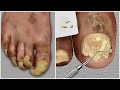[ASMR] 두꺼운 무좀 발톱 케어 애니메이션 / thick athlete&#39;s foot toenail treatment animation