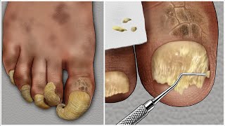 [ASMR] 두꺼운 무좀 발톱 케어 애니메이션 / thick athlete&#39;s foot toenail treatment animation