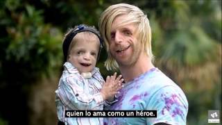 Jono Lancaster sindrome:(treacher collins)