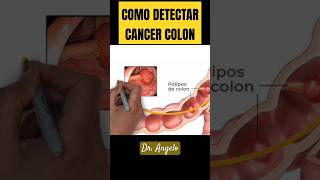 Así SABES SI TIENES CANCER DE COLON y RECTO #doctor #consejos #ciencia #salud #dr